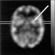 compartment filled with increased activity to simulate a 67% increase in perfusion during an intraical phase