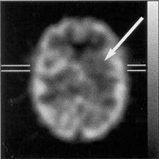 Compartment filled with decreased activiity to simulate 67% reducation in perfusion during an interical phase