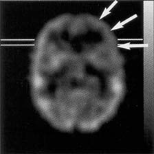 compartment filled with decreased activity to simulate a 33% reduction in perfusion in the left frontal lobe