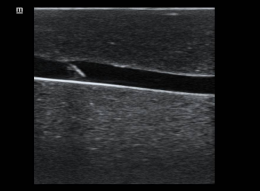 Internal jugular trainer ultrasound example 2