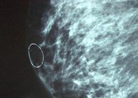 Xact&regl Mole Markers Scan Image