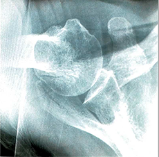 Auxiliary Pillow - Shoulder X-ray - XIC