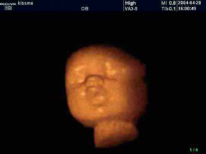 Baby's Head Teaching Ultrasound Phantom ATS 3DBH 2