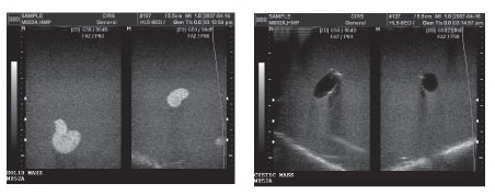 Breat Ultrasound Needle Biopsy Phantom CIRS 052A Ultrasound Image