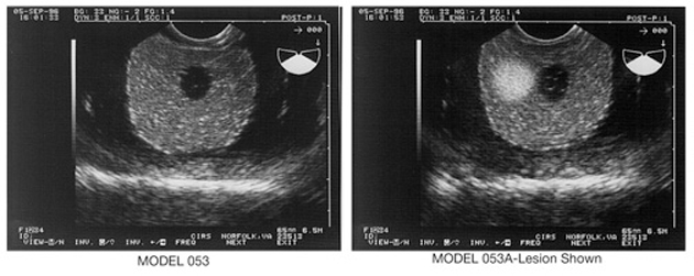 Ultrasound Prostate Training Phantom CIRS 053 Tissue Equivalent/Cryotherapy ultrasound image