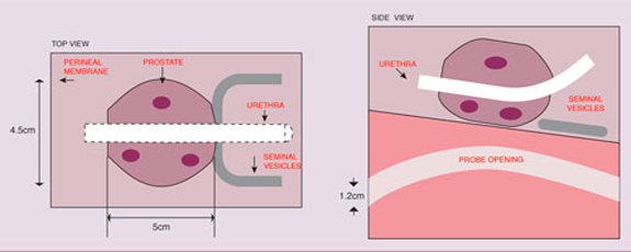 [DIAGRAM] Prostate Ultrasound Biopsy Diagram - WIRINGSCHEMA.COM