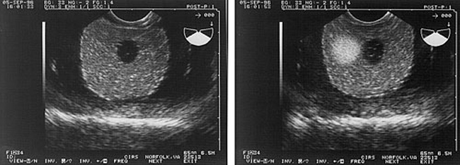 Prostate Ultrasound Demonstration Phantom CIRS 058 Ultrasound Image