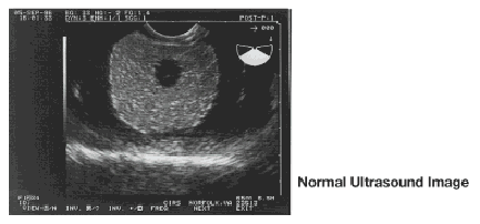 Prostate Elastography Ultrasound Phantom CIRS 066 Ultrasound Image