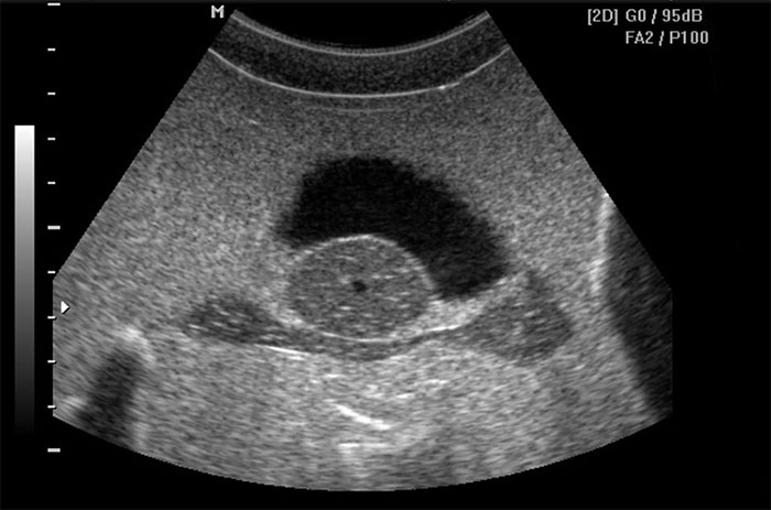 pelvic sonogram pelvic sonogram