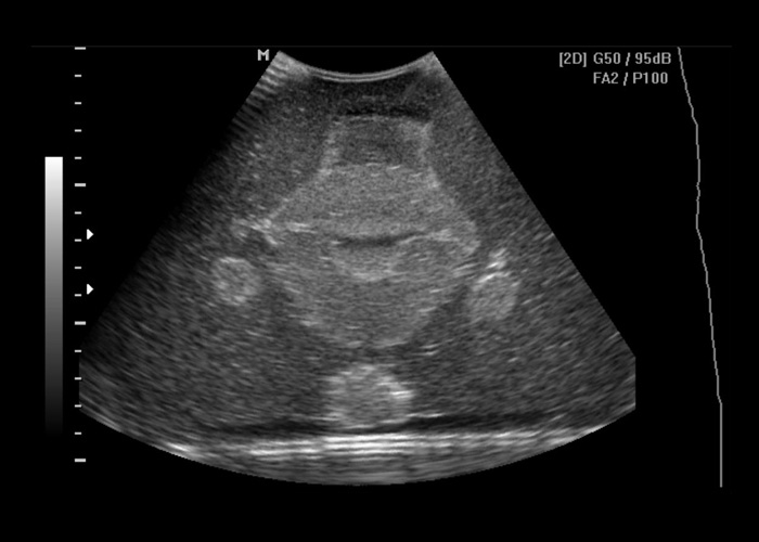 Ultrasound Image Trans-vaginal of Uterus