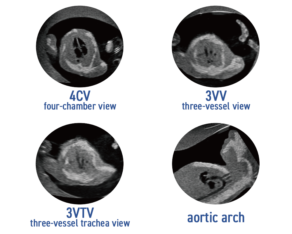 SPACE FAN-ST Heart fetal echocardiography views