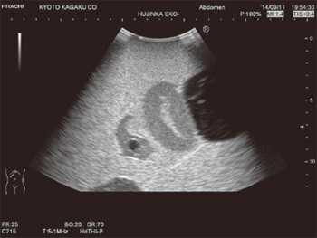 US-10 - Ectopic Pregnancy Phantom - Ultrasound 1