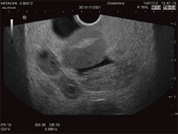 US-10 - Ectopic Pregnancy Phantom - Ultrasound 2