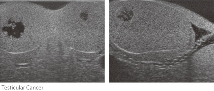 Ultrasound of Pathological Scrotal Ultrasound Phantom - Kyoto Kagaku - US-11