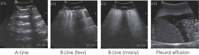 Lung Ultrasound Training Phantom - Kyoto Kagaku - US-19 - Ultrasound Images