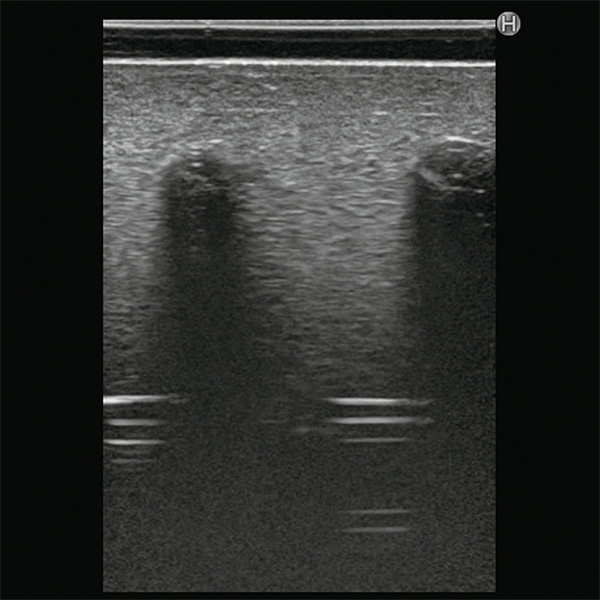 Ultrasound Compatible Lumbar Puncture / Epidural Simulator - M43E - Kyoto Kagaku - Ultrasound 1