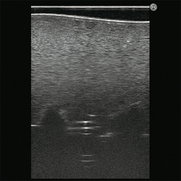 Ultrasound Compatible Lumbar Puncture / Epidural Simulator - M43E - Kyoto Kagaku - Ultrasound 2