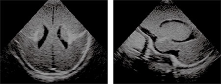 Ultrasound Neonatal Head Phantom (Normal) - US-14A - Kyoto Kagaku
