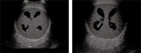 Ultrasound Neonatal Head Phantom (Hydrocephalus) - US-14B - Kyoto Kagaku