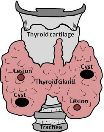 Schematic of the thyroid phantom lesions and cyst